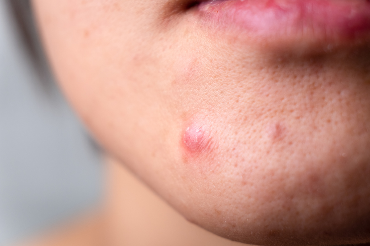 Person with a Pimple on Chin